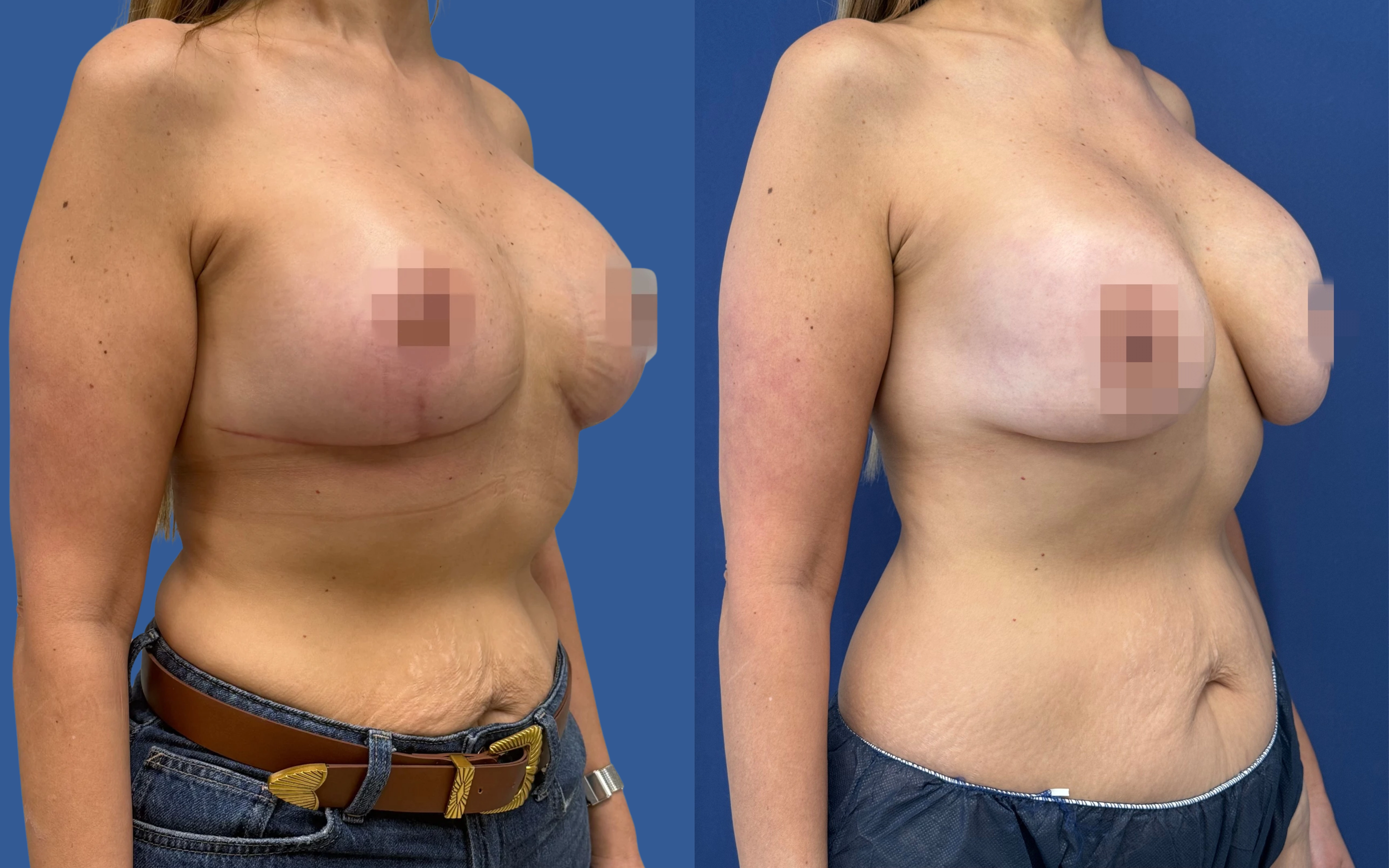 תמונת לפני ואחרי ניתוח חזה בגישה טבעית אצל ד״ר דוד טל